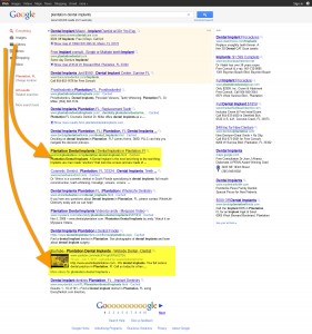 SEO for Dentist - SEO Case Study - Plantation Dental Implants SEO for Dentist - SEO Case Study - Plantation Dental Implants